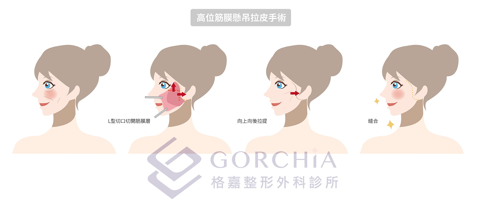 高位筋膜懸吊拉皮手術(High SMAS facelift)
